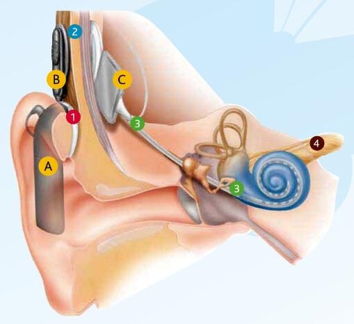 【自述】聊一聊我在民生耳鼻喉医院治疗耳聋的